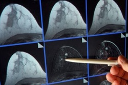 Photo: Verkürzte Bestrahlung bei Brustkrebs bringt Vorteile für Patientinnen