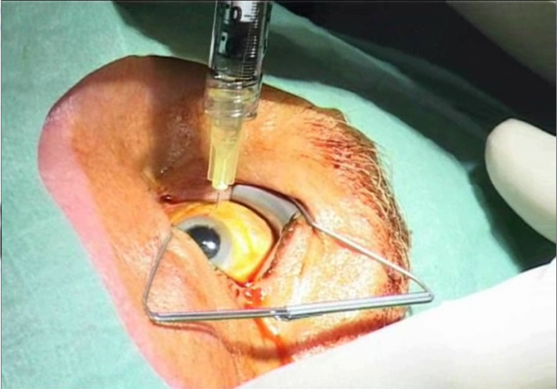 An intravitreal injection (IVI)