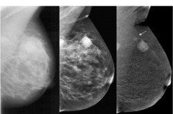 Die kontrastmittelverstärkte spektrale Mammographie (CESM)