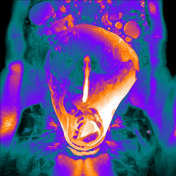 Das kernspintomographische Bild zeigt einen gesunden menschlichen Fetus