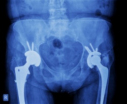 An X-ray showing a right and left hip has been replaced,
