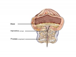 Auf dem Bild klar zu erkennen, ist die erweiterte Prostata.