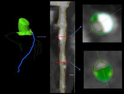 These images are from a 62-year-old man. Left: coronary segmentation model of...