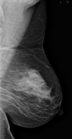 3D-Mammographie
Ausschnitte links: inmitten des dichten Drüsengewebes zeigt...