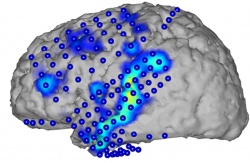 Mittels Elektrokortikographie wird Gehirnaktivität aufgezeichnet (blaue...