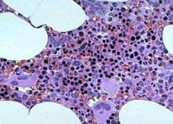 Photo: Bone marrow cells given gene therapy shield