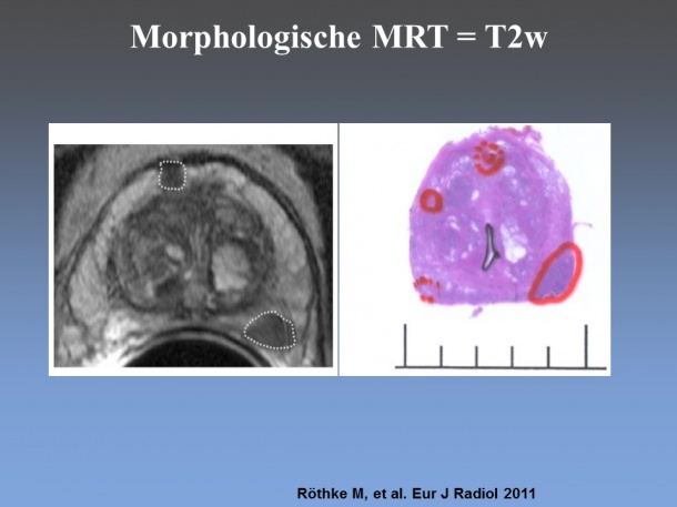 Comparison MRI - Pathology: On the left morphological T2-weighted MRI and on...
