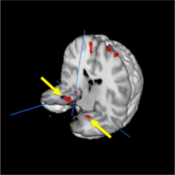 Scan shows anterior temporal lobe.