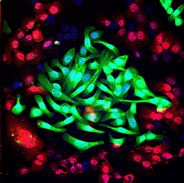Lung cancer cells (green) cultured together with normal lung cells (red). The...