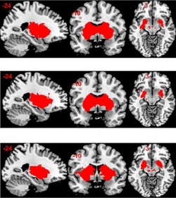 The MRI image clearly shows how the brains reward, or limbic, system behaves...