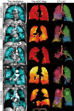 Images in representative patients with mild-to-moderate or severe COPD are...