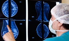 An in-depth trial shows that benefits of mammographic screening are likely to...