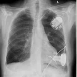 Röntgen-Thoraxaufnahme eines Patienten mit Herzschrittmacher und LVAD...