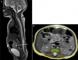 MRI images of the spine in a 3-day-old newborn.