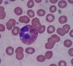 Mikroskopische Aufnahme eines Blutausstrichs: ein eosinophiler Granulozyt...