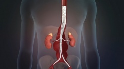 Sanford Health vascular surgeon Pat Kelly developed a stent graft that can be...