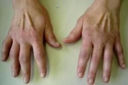 Die Rheumatoide Arthritis wird oft erst sehr spät diagnostiziert.