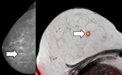 Der auffällige Befund der Röntgen-Mammographie (links) bestätigt sich bei...