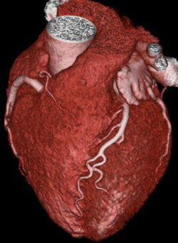 Cardiac CT without CAD.