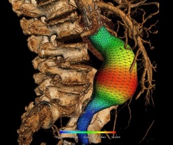Virtual models can be created in the angiography room thanks to an approach...