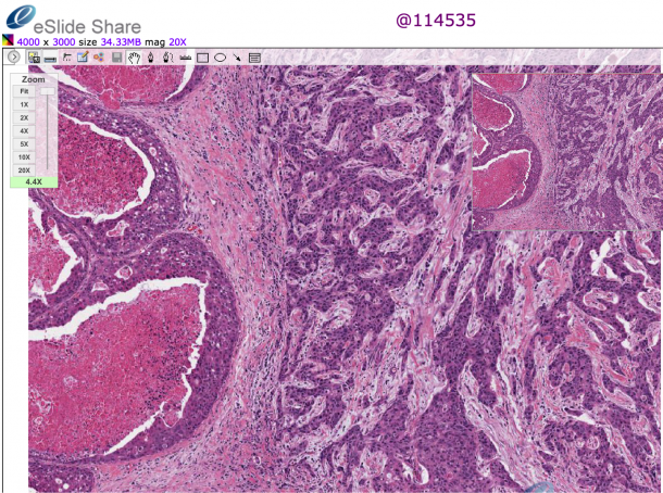 Telepathological depiction of a breast tumour in virtual microscopy.