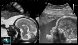 Foetal brain sagittal view illustrated via Hitachi Aloka’s Fusion Imaging...