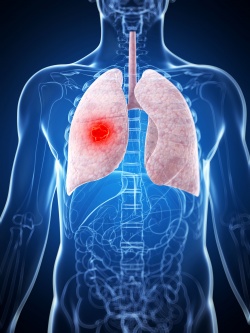Clinical validation for new lung cancer test.