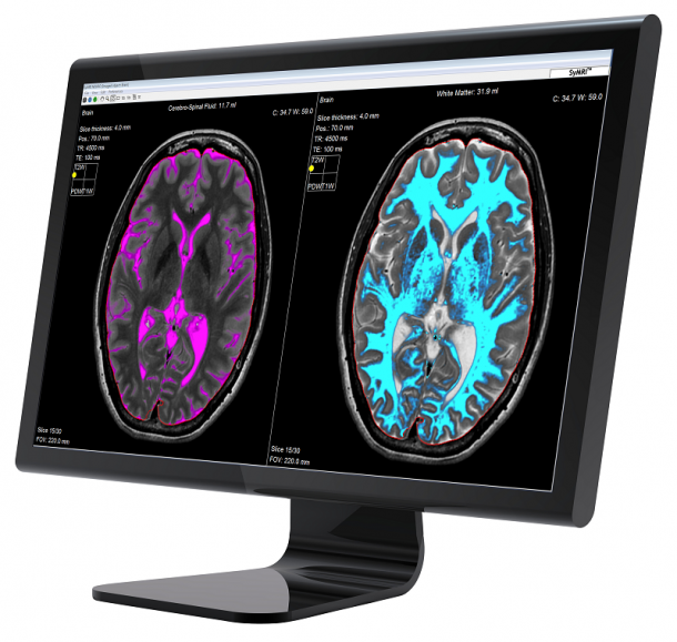 Photo: SyMRI to be studied as a technology to characterize brain tumors