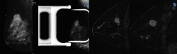 Mammography and MR imaging in a 46-year-old woman with a palpable mass in the...