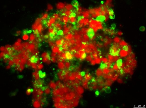 Colon cancer cells. The ones in red are unharmed. The ones in green are...
