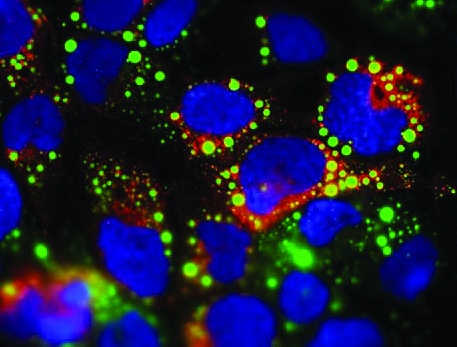 HCV-infizierte Zellen: An den grünen Fetttröpfchen werden die Viren...