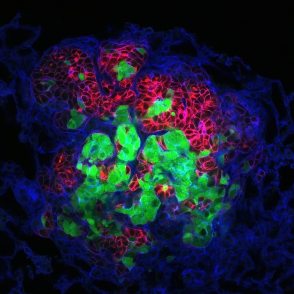 A metastasis now growing in lung tissue (blue) that originated from at least...