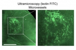 Brain tumor microvessels are visualized using dual-color ultramicroscopy.