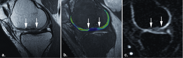 Sodium cartilage transplant: a morphological MR image of a cartilage transplant...