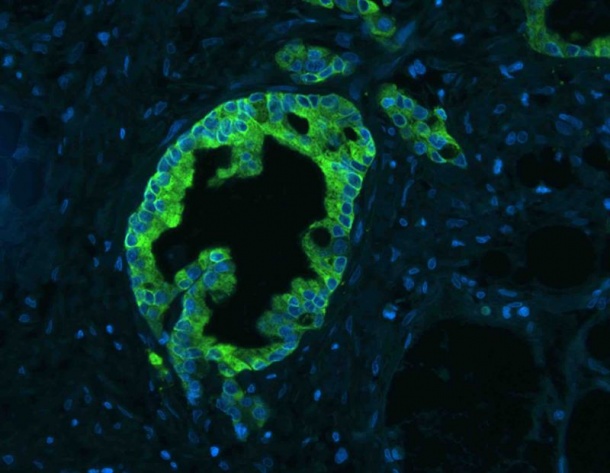 Menschliche Bauchspeicheldrüsenkrebszellen. Zellkerne sind blau gefärbt. In...