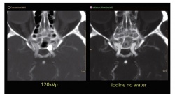 Left: Conventional CT image with clearly visible artifacts after embolisation...