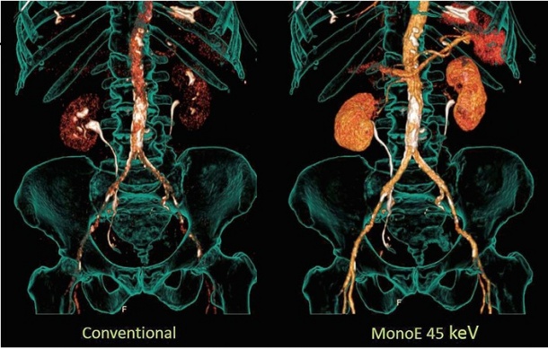 Comparison of conventional and mono-energetic images: Looking at low...