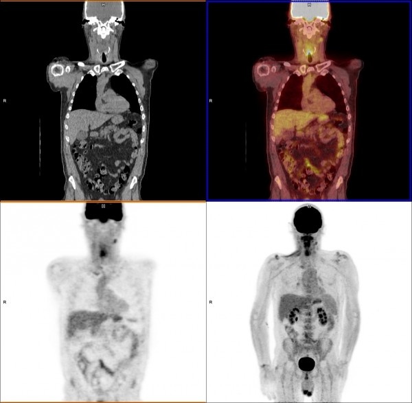 Scans showing the remaining surviving cancer cells after treatment.