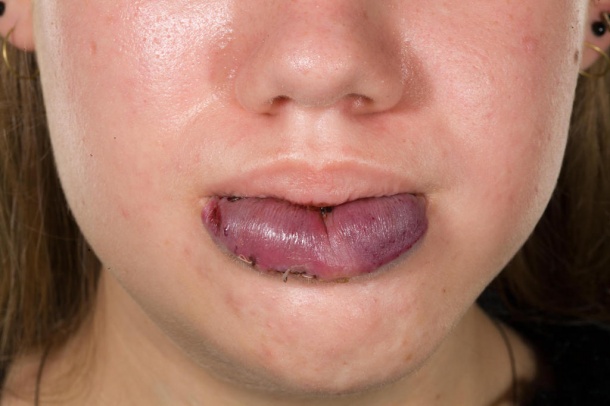 Child with venous malformations on the lip.