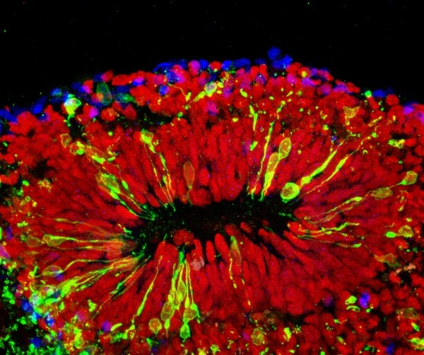 A mini-brain infected with Zika virus. The virus is shown in green, vulnerable...