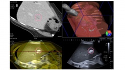 Selbe Patientin wie in Bild 1 gezeigt, Staging CT mit Raumforderung der Leber...