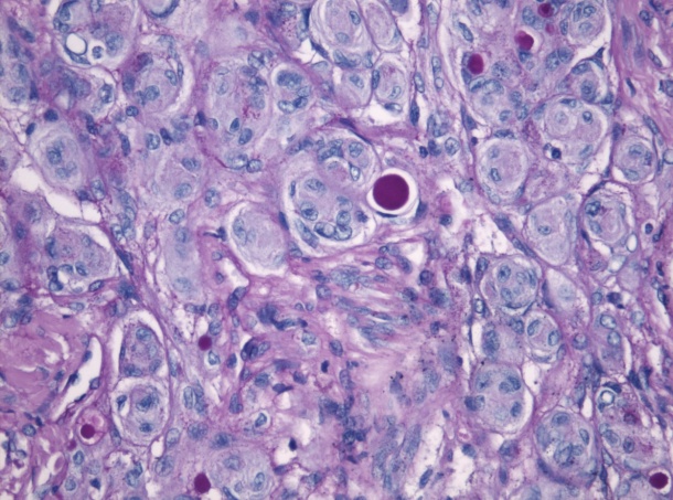 Hirntumor-Zellen (Meningeom-Zellen) unter dem Mikroskop.