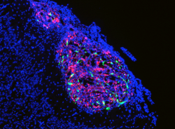 Glioblastoma cells.