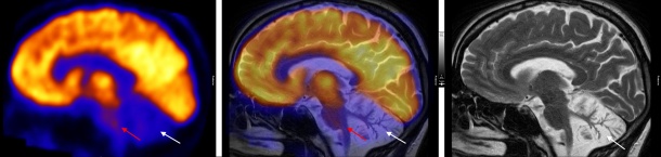 Stoffwechselaktivität des Gehirns (links: PET) und Struktur des Gehirns...