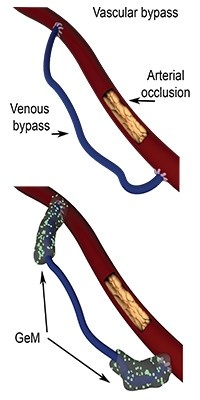 vascular bypass