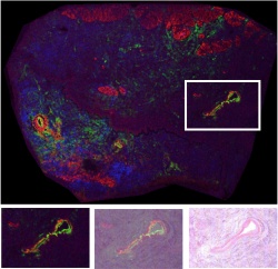 Proteins in gastric Cancer at 30m pixel size. The microscopic image can be...