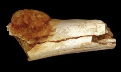 Fossile Zehe: Krebs nachgewiesen.