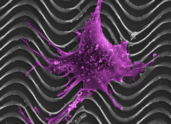 A  normal ovarian epithelial cell clings to a tiny model of an ovarian cancer...