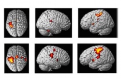 fMRI during simple motor task; healty volunteer 8top) and PP MS subject...