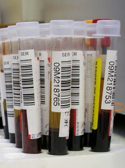 Photo: Krebsspuren im Blut spiegeln Therapieerfolg